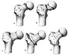 <b>Fracturas</b> del cuello del <b>fémur</b>