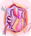 <b>pulmonary vein</b> (RSPV).