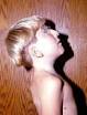 This patient has <b>Klippel</b>-<b>Feil</b>
