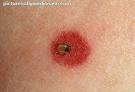 Lyme Disease Skin Rash
