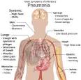 Pneumonia - Wikipedia, the free encyclopedia