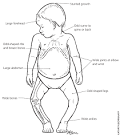 <b>Rickets</b> can make your child's
