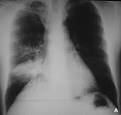 <b>Atélectasie</b> du lobe moyen.