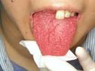 <b>Glossitis</b> Images