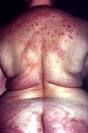 Leprosy (Hansen's disease)
