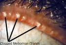 gland <b>disease</b>, meibomitis
