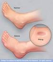 <b>Edema</b> in ankle