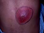 Clinical: <b>abscess</b>.