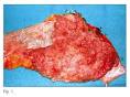 como <b>adenoma velloso</b> con
