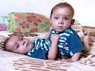 <b>Gêmeos</b> siameses de MT <b>unidos</b>