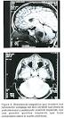 Los tumores cerebrales