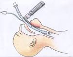 <b>Intubation</b>