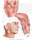 <b>Tumors</b> of <b>Hypopharynx</b>