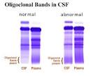 <b>Oligoclonal Bands</b> in CSF in a