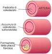 <b>Aterosclerosi</b>
