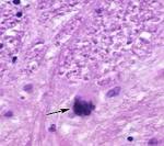 Central Nervous System Infections Associated with Human ...