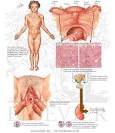 Syndrome of <b>Gonadal Dysgenesis</b> (Turner's Syndrome) - Netter