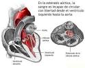 20110623 mgb Estenosis <b>aórtica</b>