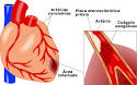 <b>Infarto</b> ou enfarte <b>do</b>
