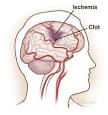 <b>thrombolytic therapy</b> in