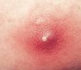 Şankroid (Yumuşak Çıban) nedir Genital Herpes belirtileri