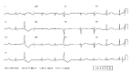 with <b>Romano</b>-<b>Ward syndrome</b>.