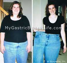 bypass surgery