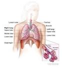 <b>Non</b>-<b>Small Cell Lung Cancer</b>