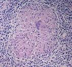 <b>Granuloma</b> Ode to the <b>granuloma</b>