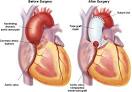 but whose <b>aortic valve</b>