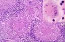 lesion in a <b>lymph node</b> and