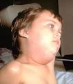 Boy with <b>Mumps</b>