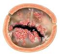 <b>Rheumatic fever</b> is an