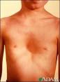 Also known as: <b>Funnel chest</b>