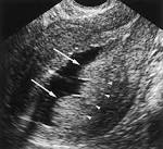 Sonohysterographic Findings of <b>Endometrial</b> and Subendometrial