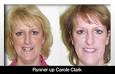 Girl's Dental Braces Stops Bullies - 0810_Carole_Clark