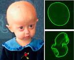Hutchinson-Gilford-<b>Syndrom</b>