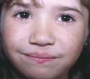 <b>Rothmund</b>-<b>Thomson</b>. <b>Syndrome</b>