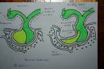 <b>Empty Sella Syndrome</b> Empty Sella Syndrome k-ng.blogspot.com
