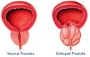 <b>Prostatitis</b> Is A Cause Of BPH