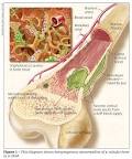 <b>osteomyelitis</b> - an extremely