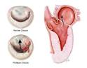 What is <b>Mitral Valve Prolapse</b>?