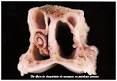 <b>RINITIS ATROFICA</b> PORCINA: Sintomatología,control y tratamiento