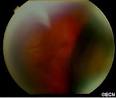 Eye Cancer Network Case #3: <b>Choroidal Hemorrhage</b> - The Eye Cancer