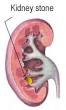 <b>lithiasis</b>) are small,