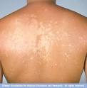 <b>Tinea versicolor</b>