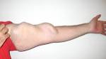 dialysis <b>fistula</b> | CHRONIC POSITIVITY - Life with Polycystic