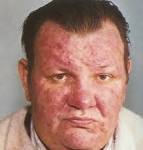 To read more about <b>Rosacea</b>-Ltd
