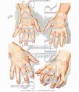 <b>Rheumatoid Arthritis</b>