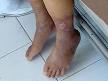 Peripheral <b>vascular disease</b>
